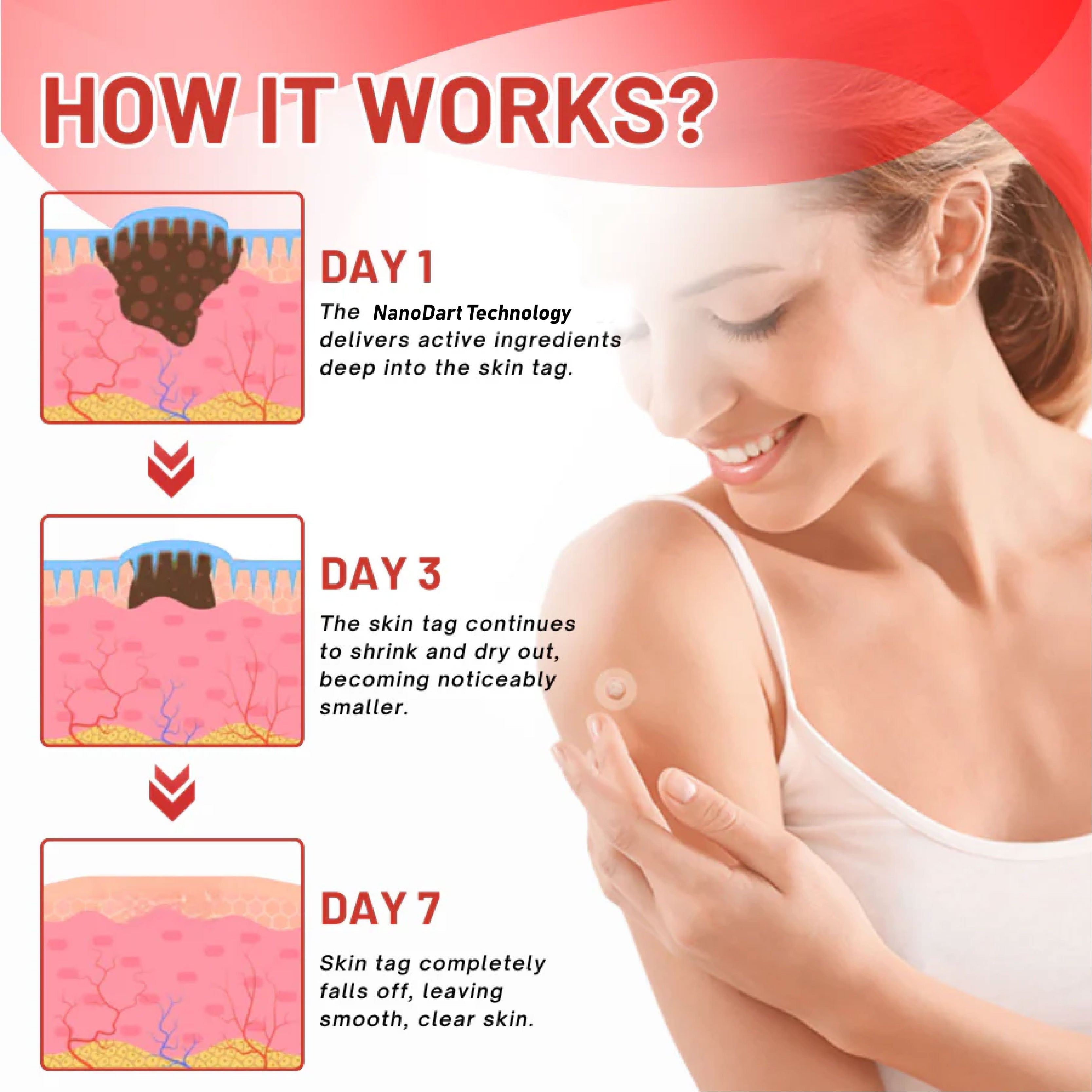 NeutralCare™ NanoDart Skin Tag Removal Patches